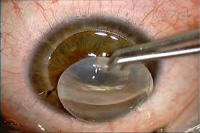 Primer trasplante en seres humanos