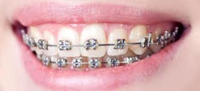 My braces
