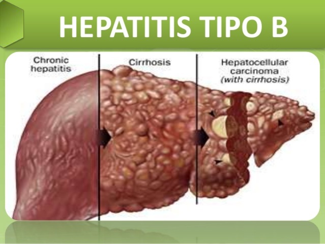 Vacuna contra la Hepatitis B
