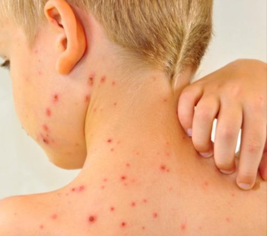 Erradicación de la viruela