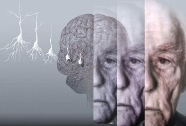 Anticuerpos contra el Alzheimer