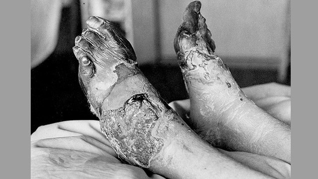 Shell Shock, trench foot, trench mouth