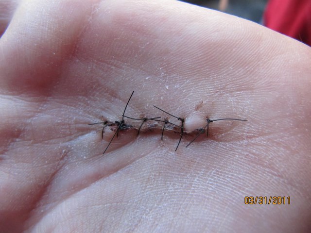Got stitches