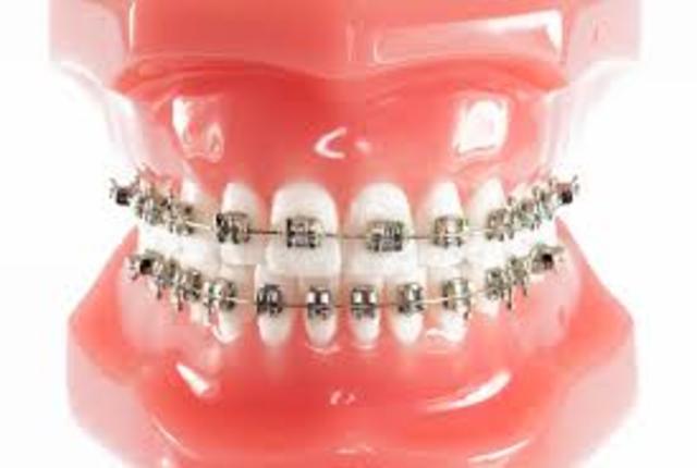 When I Got My Braces