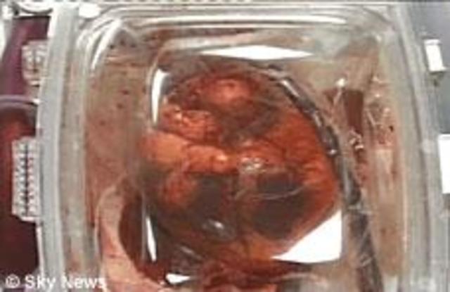 Heart transplants were halted