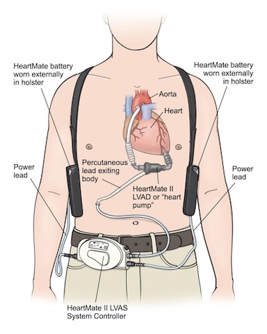 The first LVAD was implant.