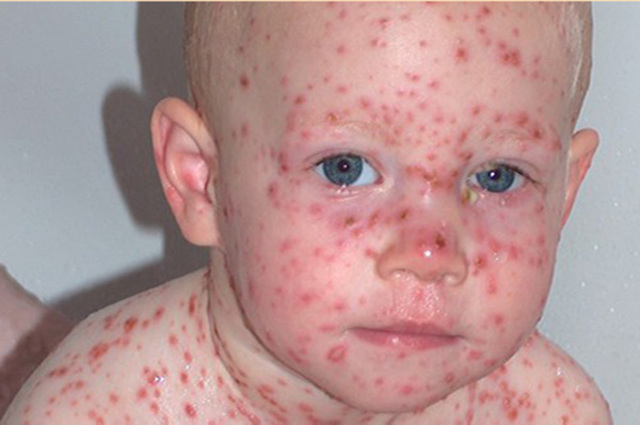 Técnicas de "inoculación" de viruela