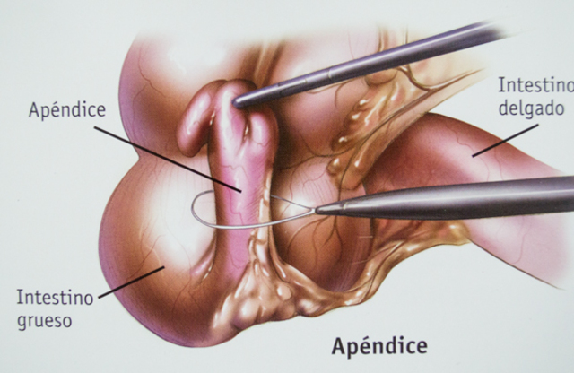 Apendicectomía