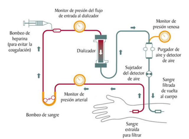 Desarrollo de la diálisis para la insuficiencia renal