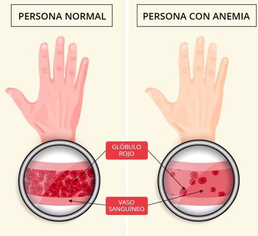 Anemia perniciosa