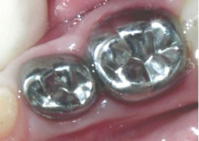 When i had to get my crowns on my teeth