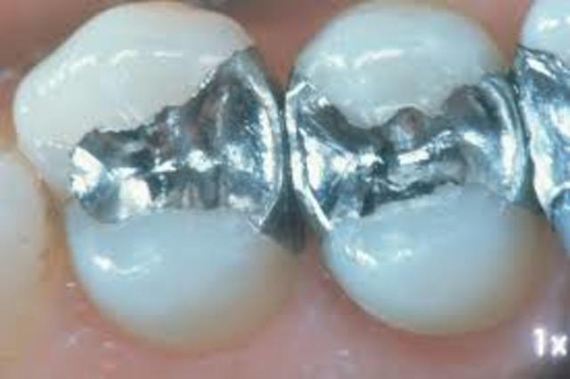 Amalgamas dentales