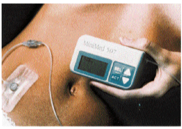 Creation of External Insulin Pumps