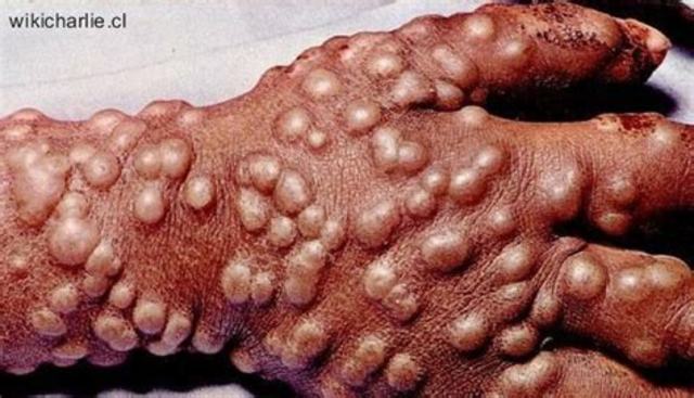 Erradicación de la viruela a través de la vacunación