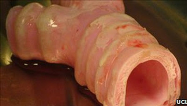 Primer trasplante de un órgano completo cultivado