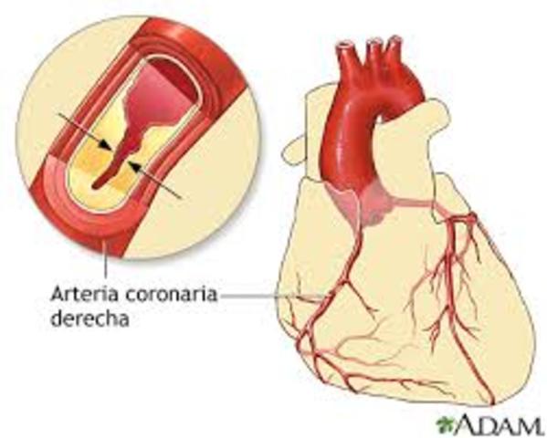 incidencia de enfermedades de las arteria coronarias