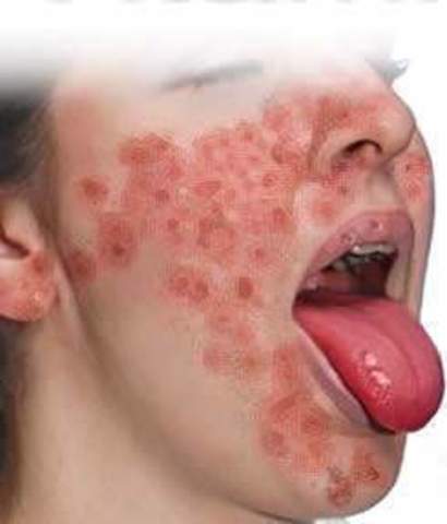 se realizan investigaciones sobre la pelagra