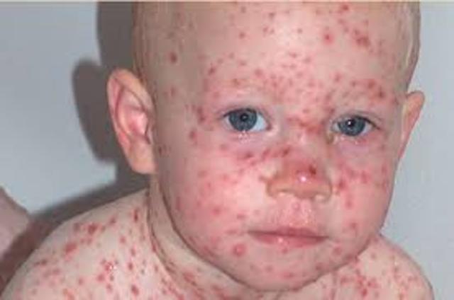 ERRADICACIÓN DE LA VIRUELA