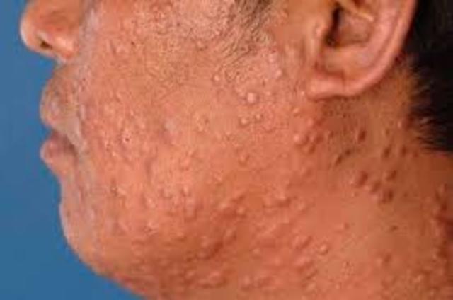 DESARROLLO DE TRATAMIENTOS PARA LA LEPRA