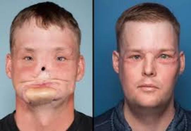 PRIMER TRASPLANTE DE CARA