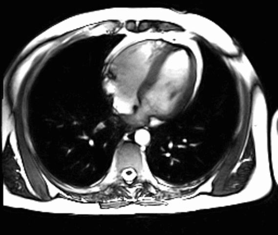 proceso de resonancia magnetica
