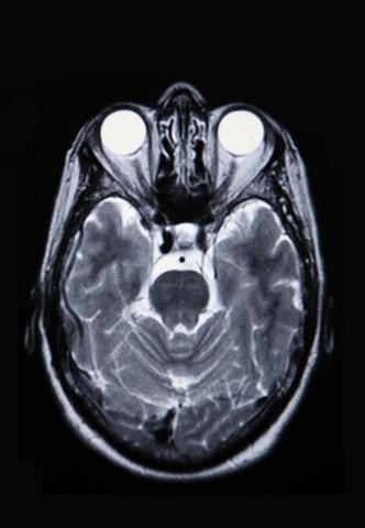 Imagen por Resonancia Magnética(IRM)