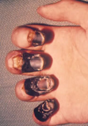 The plague is going crazy!!!