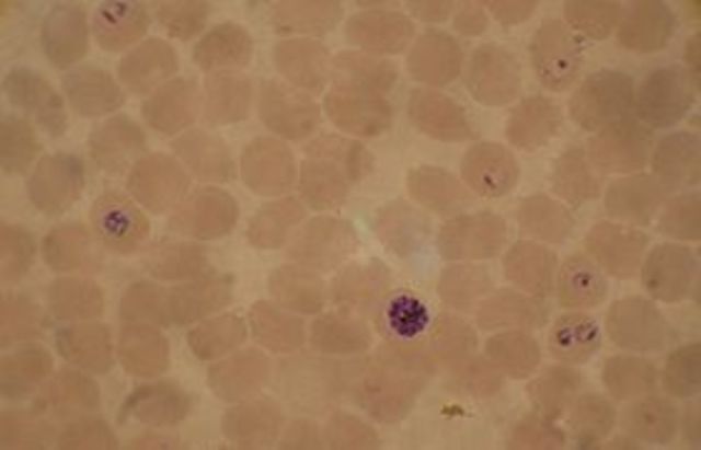 Plasmodium falciparum is described as the causative agent of malaria