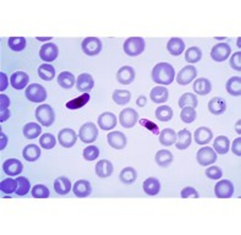 Plasmodium falciparum is described as the causative agent of malaria