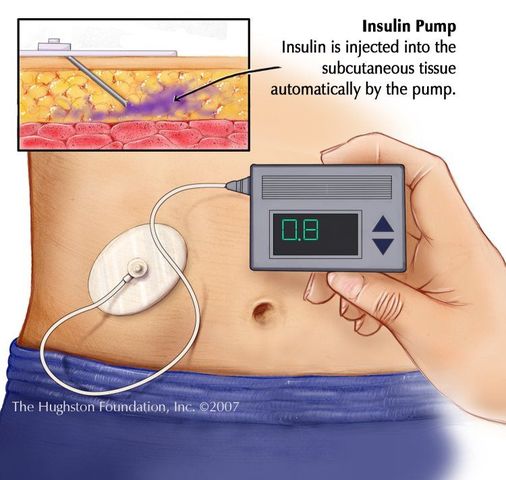 The EXTERNAL Insulin Pump Developed