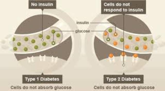 Types of Diabetes