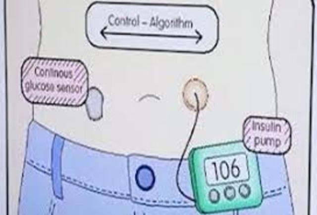 Insulin Pump