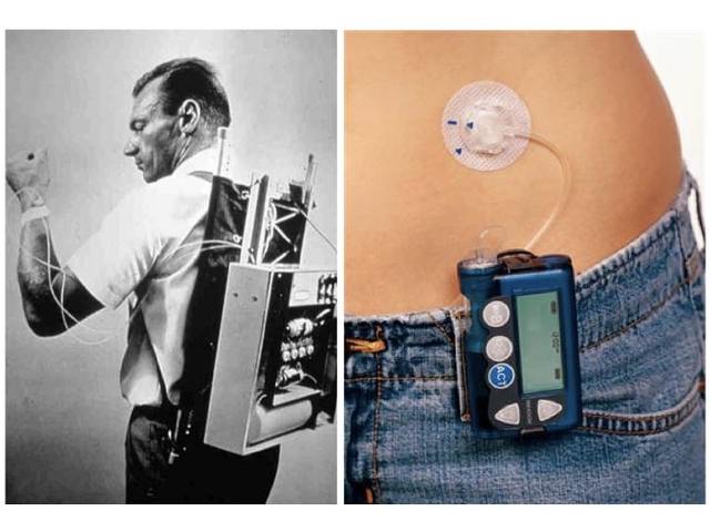 Wearable Infusion Pumps Developed