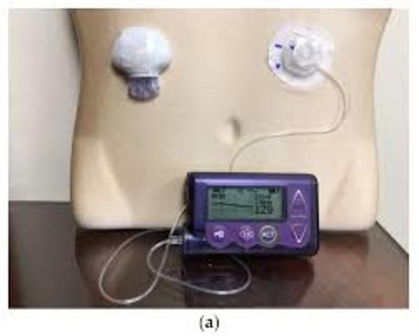 External Insulin Pump