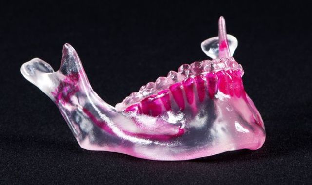 1er IMPLANTE DE MANDIBULA 3D