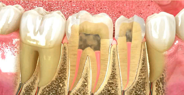 ENDODONCIA
