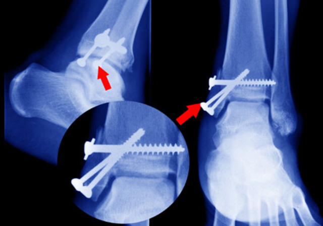 PLACAS OSEAS DE METAL(1900)