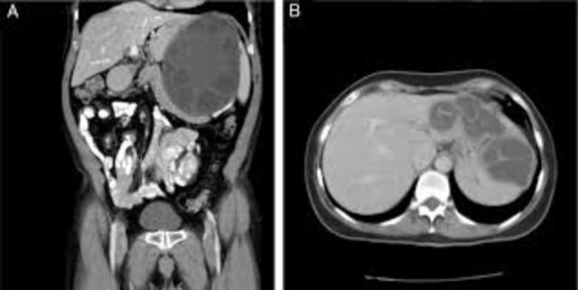 ¿Como influyó el descubrimiento de Godfrey?