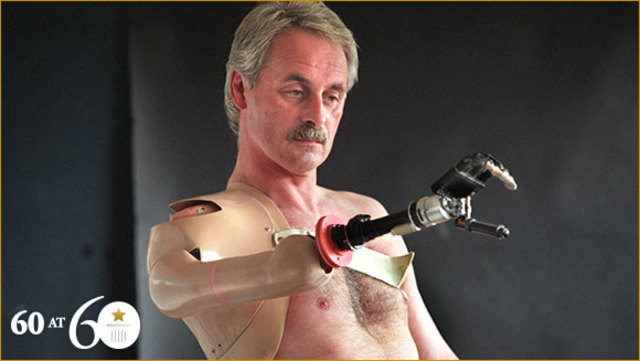 First Bionic Arm