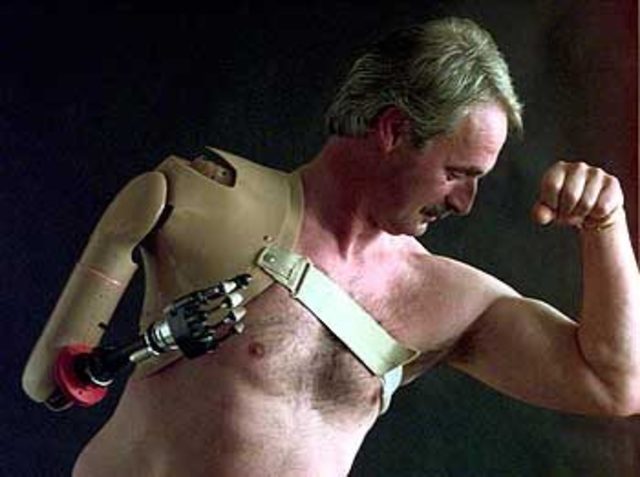 The First Bionic Arm