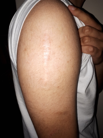 Me operaron del brazo