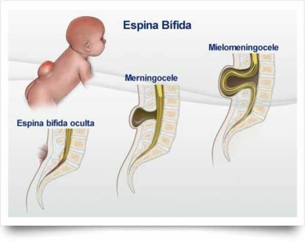 LAS ALTERACIONES EN LA MÉDULA ESPINAL