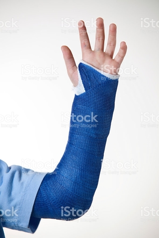 The first time I broke my arm.