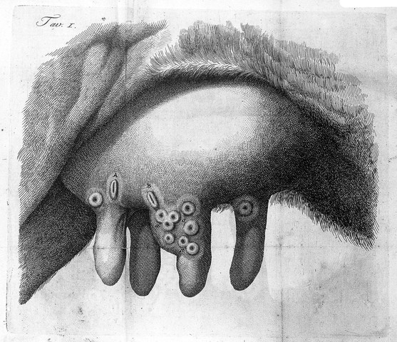 Vacunaciones contra la viruela: John Fewster