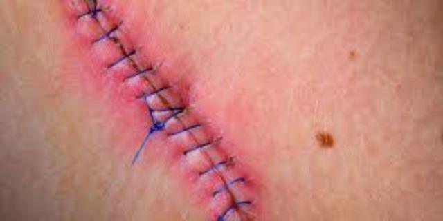 My first stiches