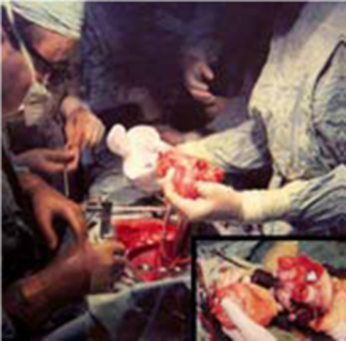 1era Implantación de corazón artificial