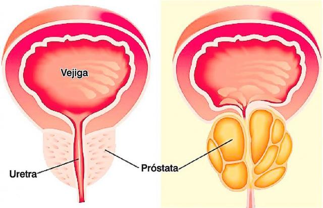 Defectos en “anillo de cohesina”,
