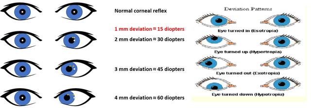 Se desarrolla el test para medir los estrabismos