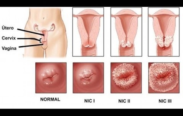 PREMIO NOBEL POR LA RELACIÓN DEL VIRUS DE PAPILOMA COMO CAUSA DEL CÁNCER (2008)