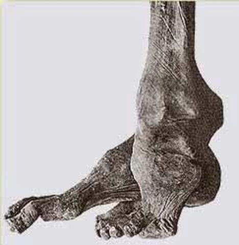 NO- evidencia de Poliomieltis